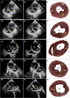 Echocardiography-guided percutaneous intramyocardial alginate hydrogel implants for heart failure: canine models with 6-month outcomes